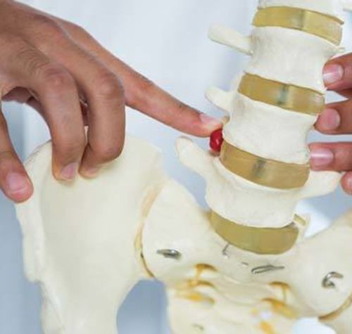 pointing-at-herniated-disc-on-spine-model