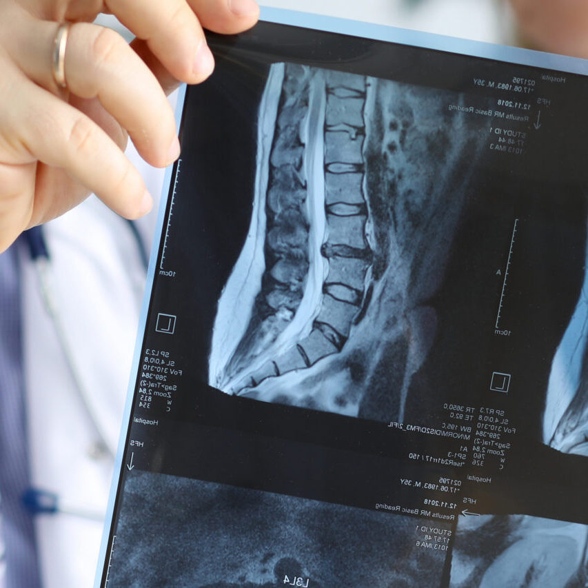 Close-up of doctors hands holding x-ray vertebra in different projections. Physician colleagues discussing diagnosis of patient. Medicine and healthcare concept