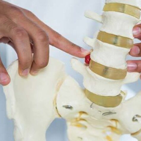 pointing-at-herniated-disc-on-spine-model